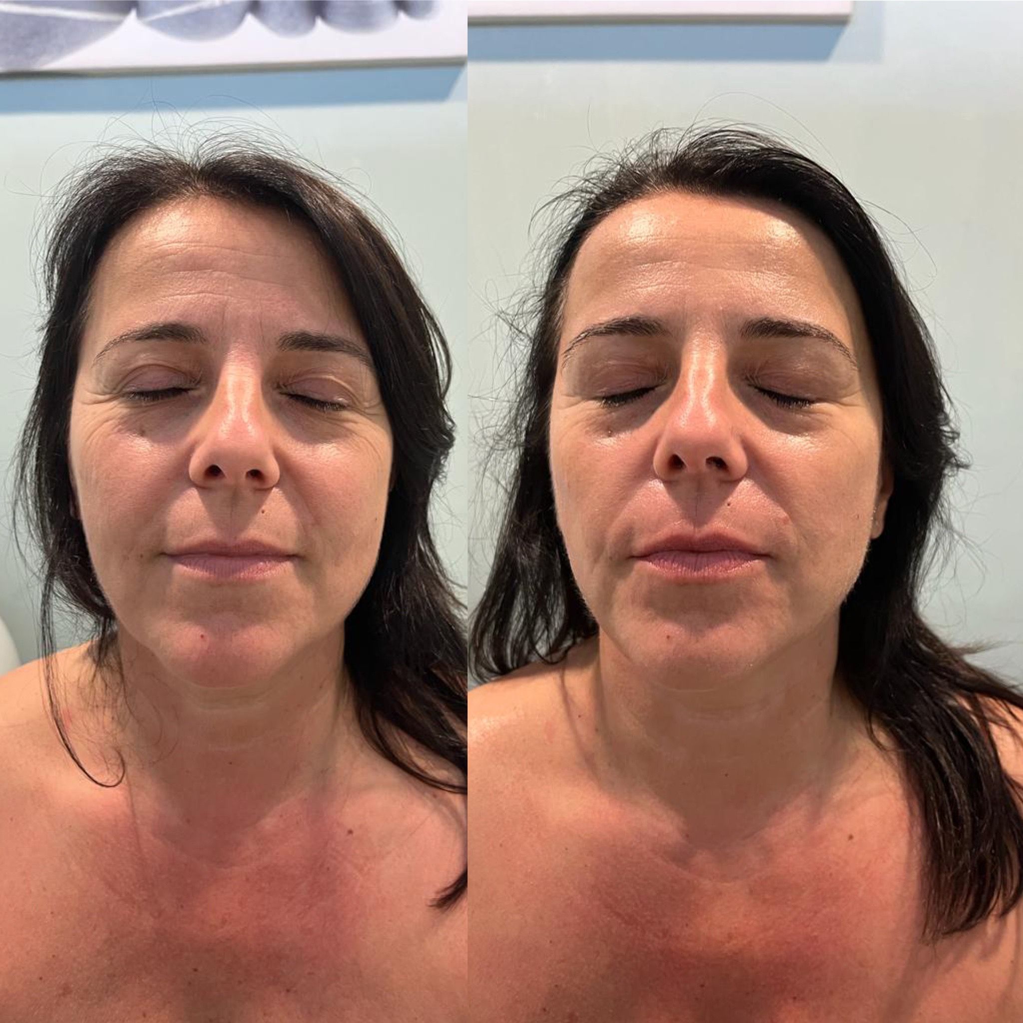 Prima e Dopo con il Dermoregen